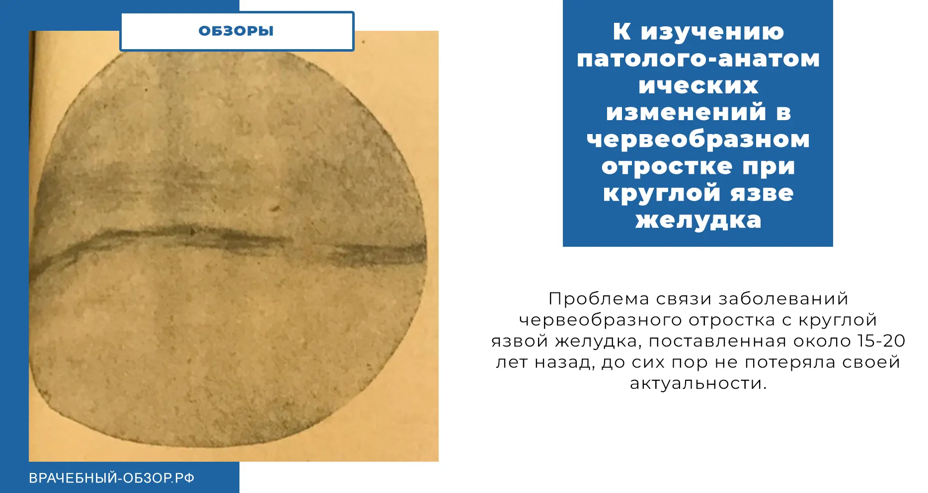 К изучению патолого-анатомических изменений в червеобразном отростке при круглой язве желудка