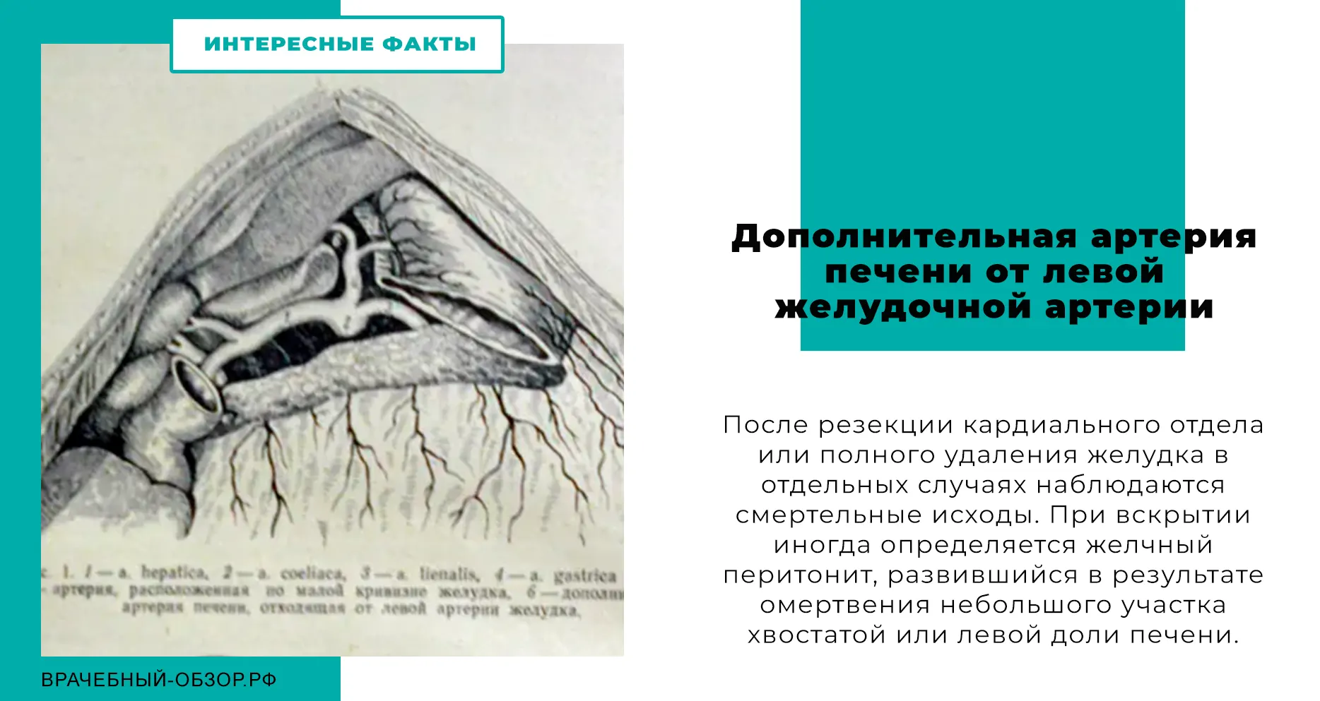 Дополнительная артерия печени от левой желудочной артерии