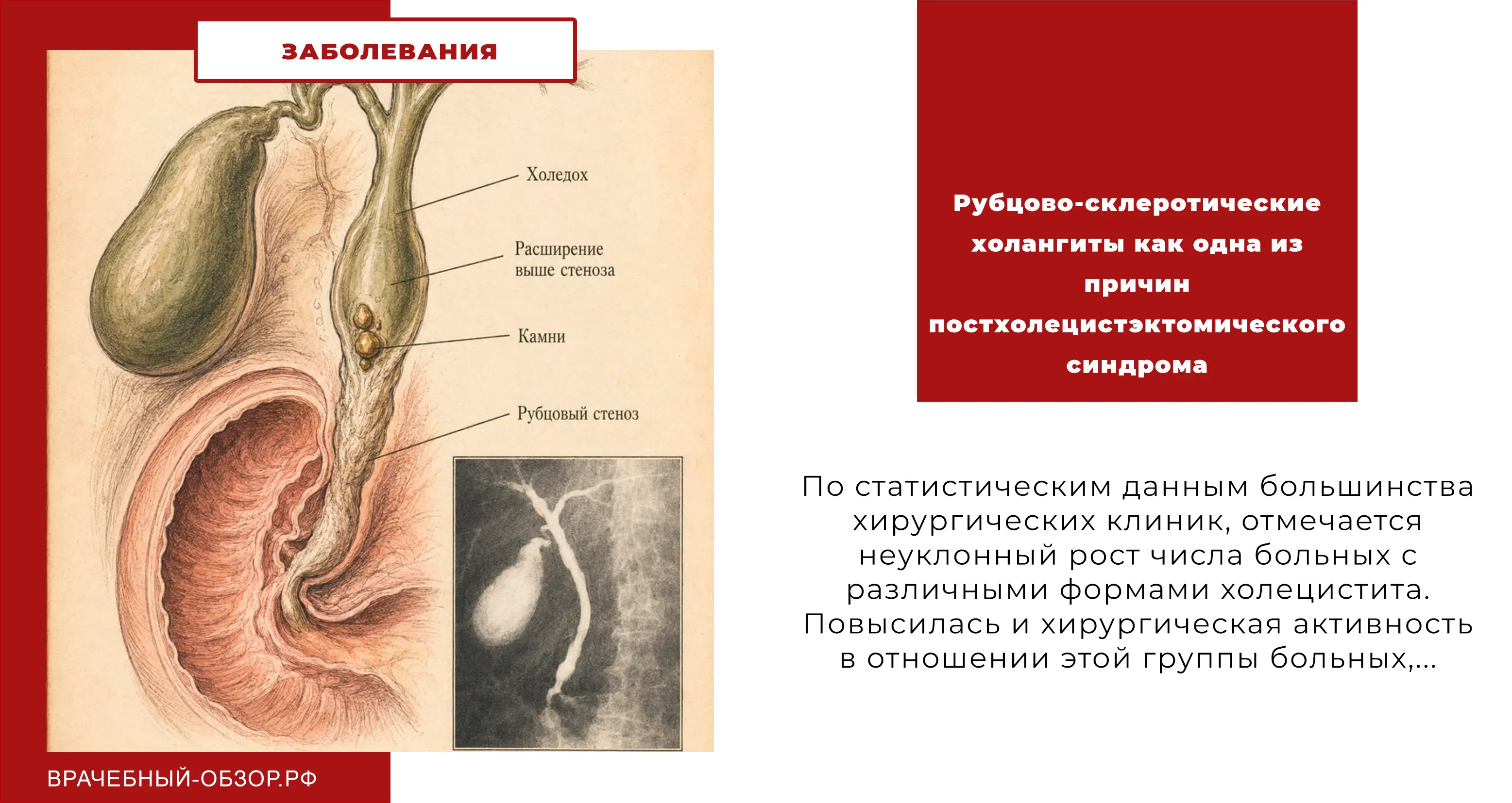 Рубцово-склеротические холангиты как одна из причин постхолецистэктомического синдрома