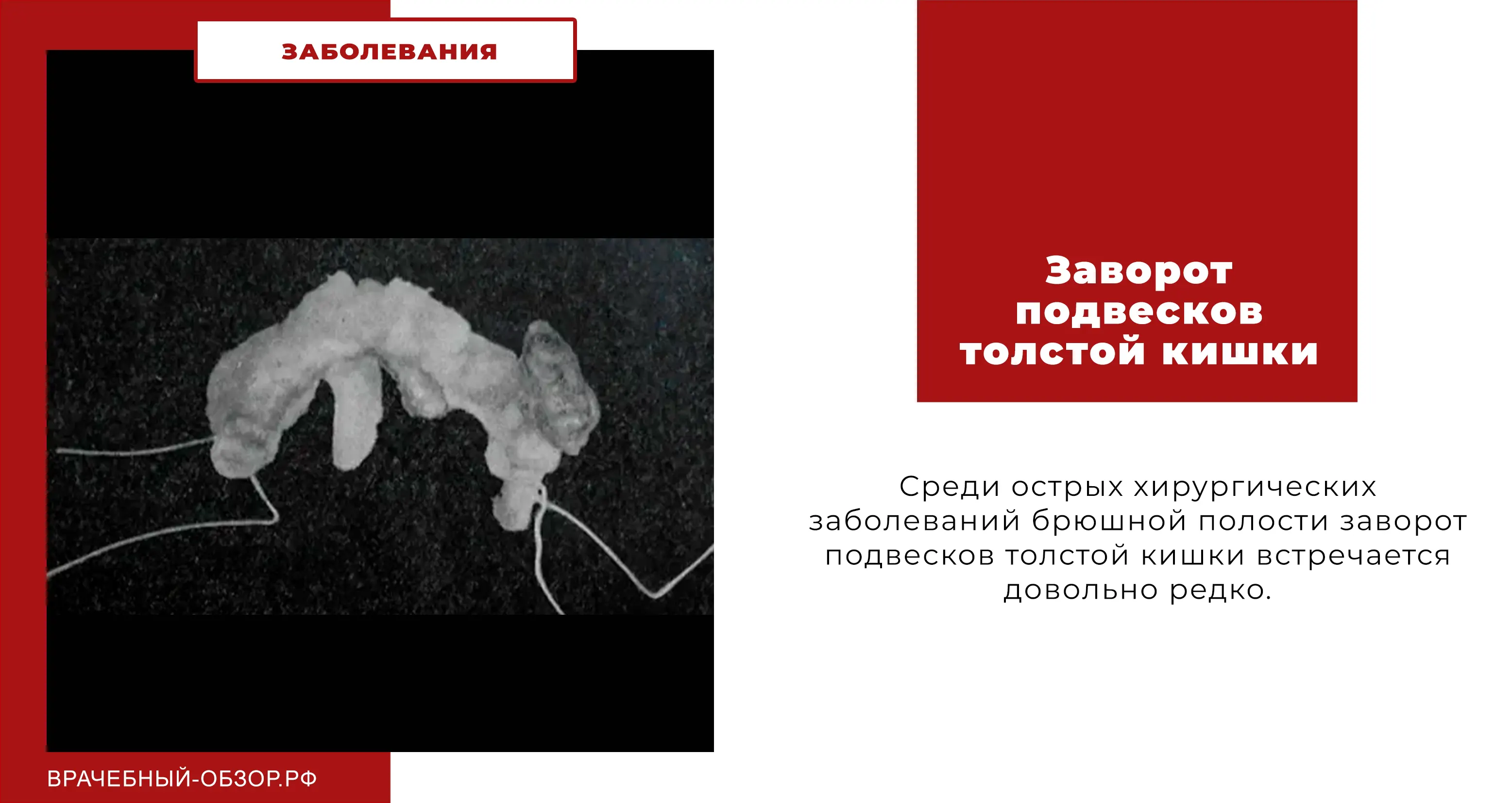 Заворот подвесков толстой кишки