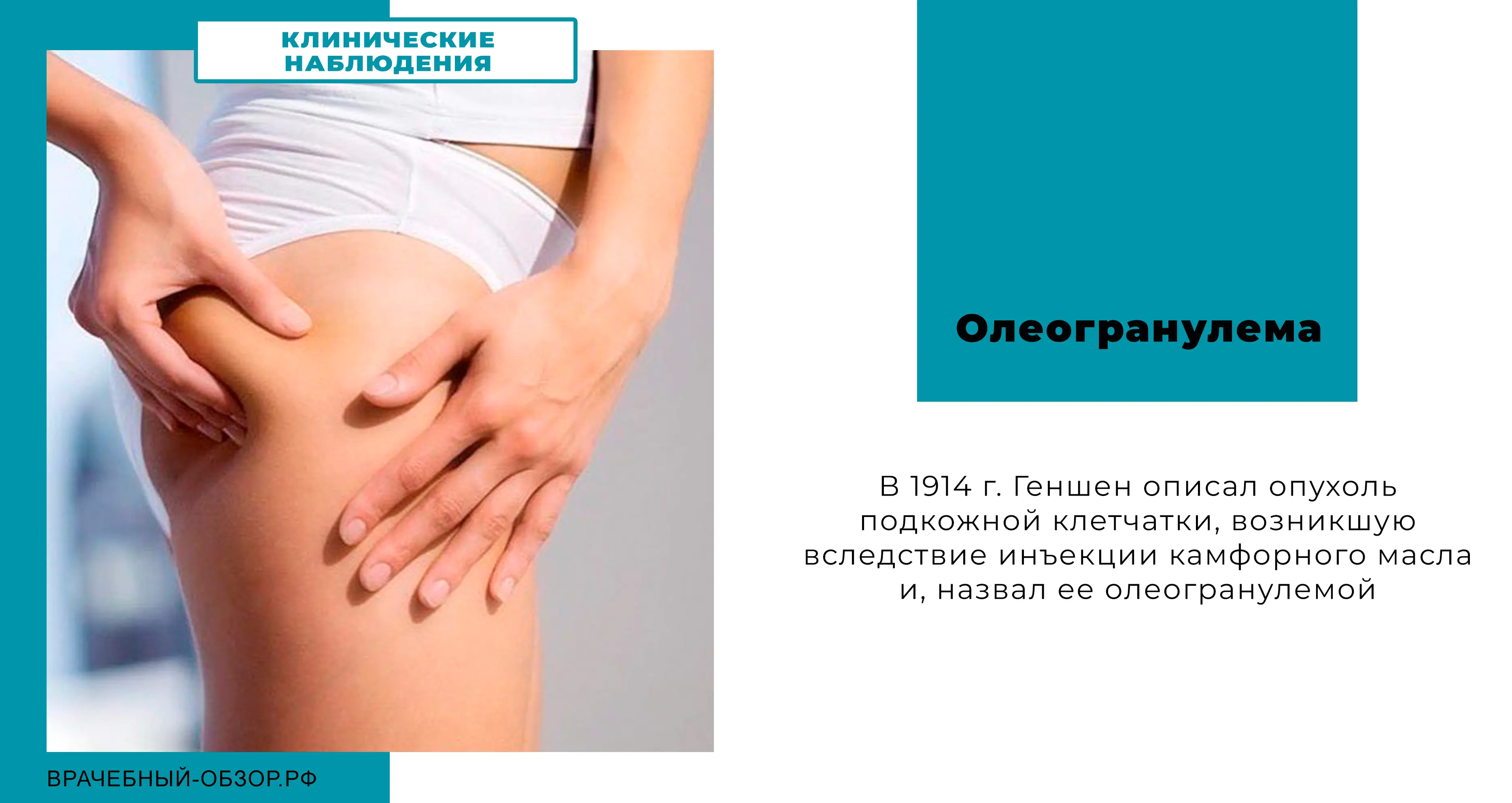 Олеогранулема