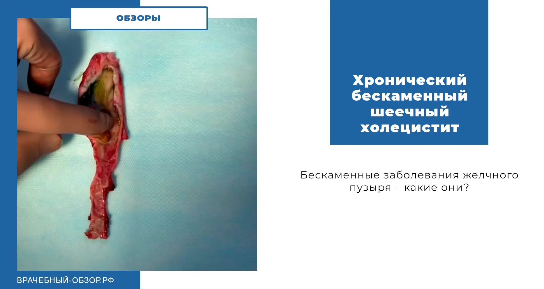 Хронический бескаменный шеечный холецистит