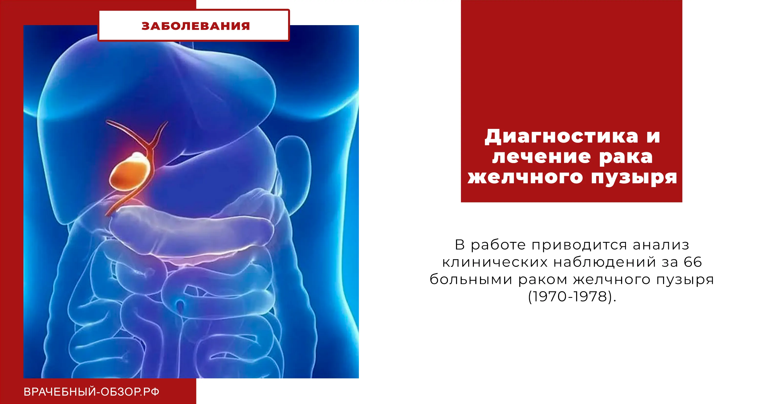 Диагностика и лечение рака желчного пузыря