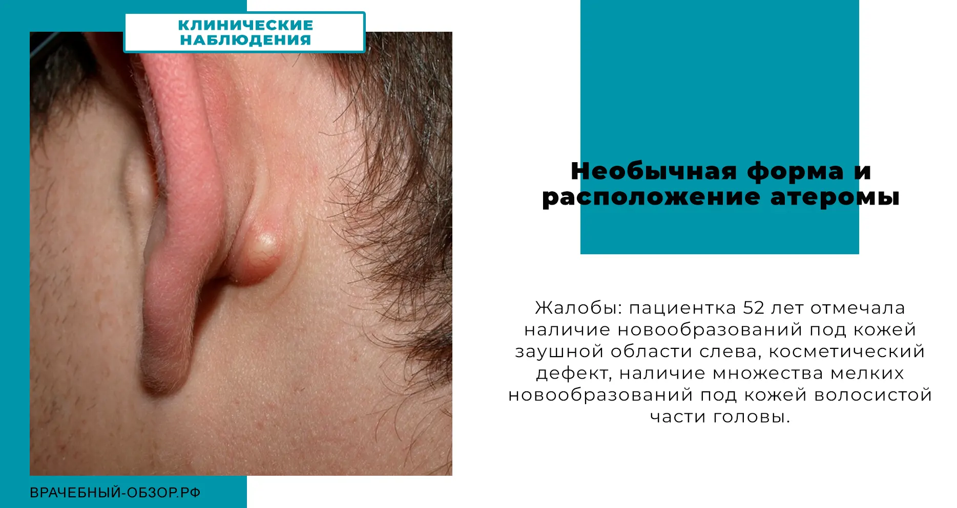 Необычная форма и расположение атеромы