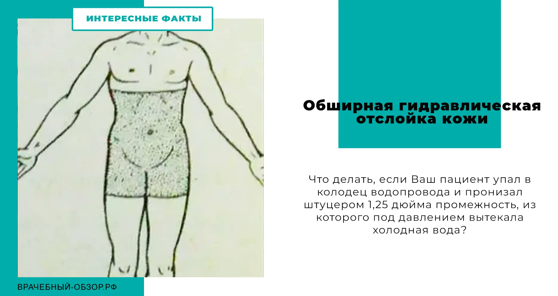 Обширная гидравлическая отслойка кожи